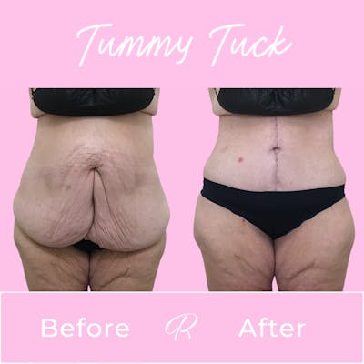 Tummy Tuck Before & After Gallery - Patient 183077033 - Image 1