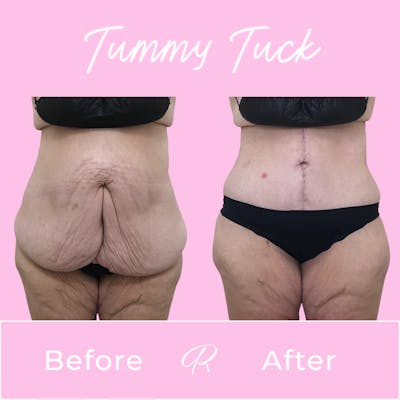 Tummy Tuck Before & After Gallery - Patient 183077033 - Image 1