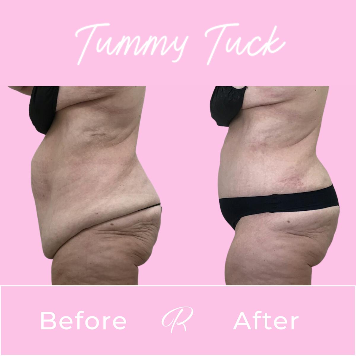 Tummy Tuck Before & After Gallery - Patient 183077033 - Image 2
