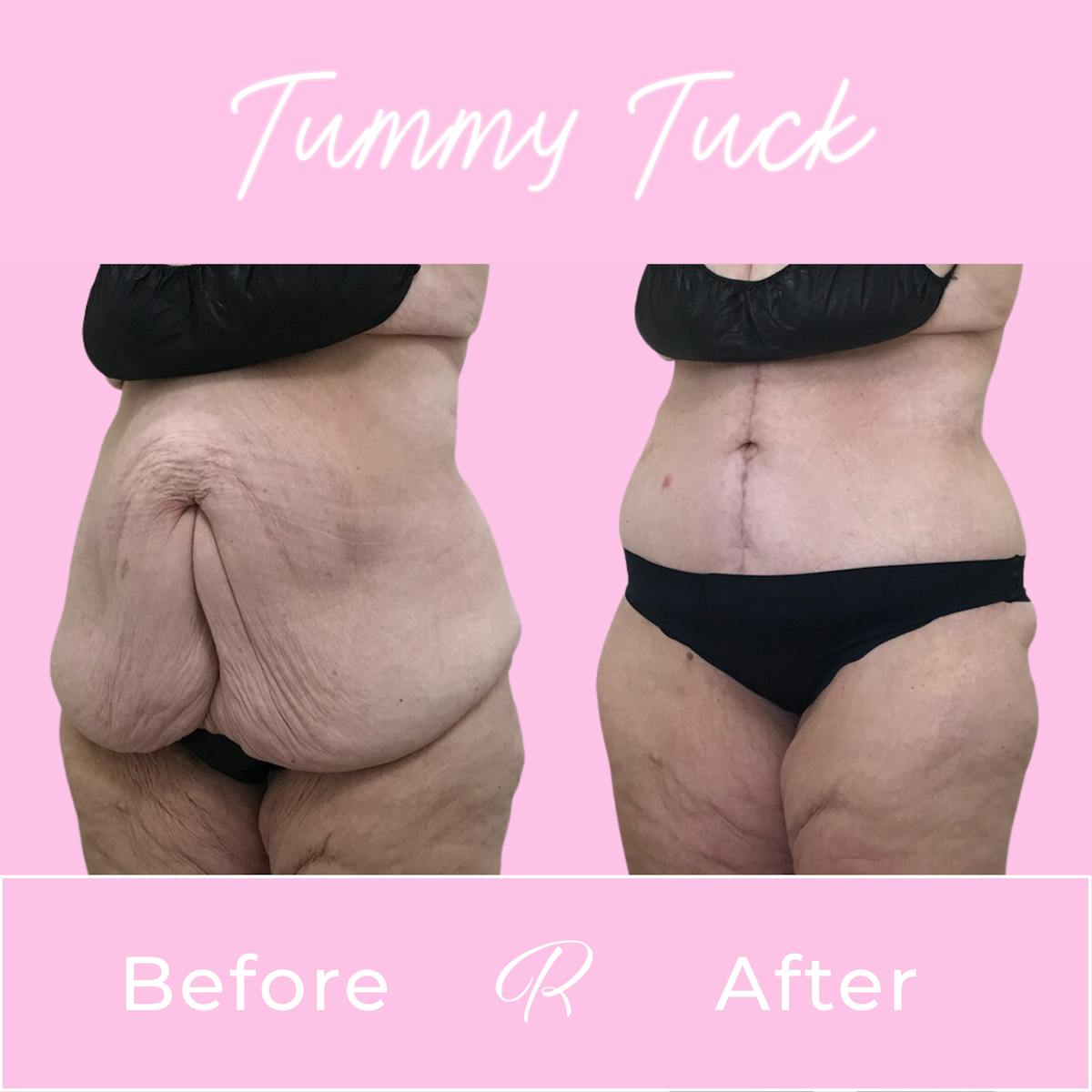 Tummy Tuck Before & After Gallery - Patient 183077033 - Image 3