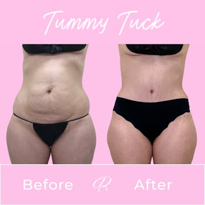 Tummy Tuck Before & After Gallery - Patient 183077032 - Image 1