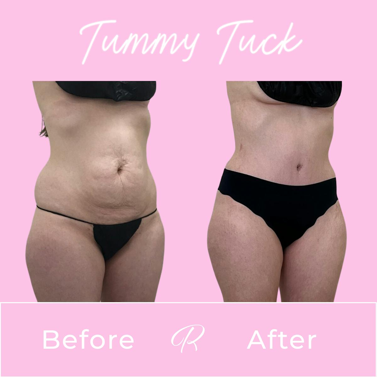 Tummy Tuck Before & After Gallery - Patient 183077032 - Image 2