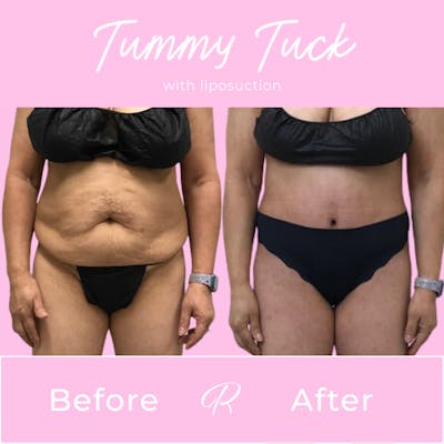 Tummy Tuck Before & After Gallery - Patient 183077061 - Image 1