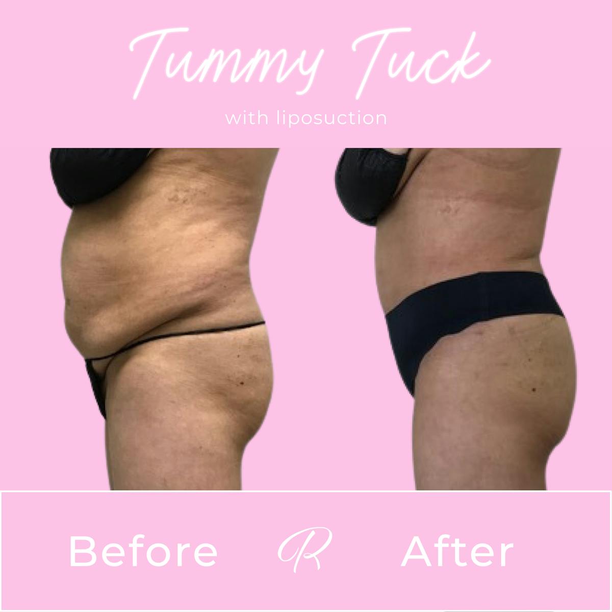 Tummy Tuck Before & After Gallery - Patient 183077061 - Image 2