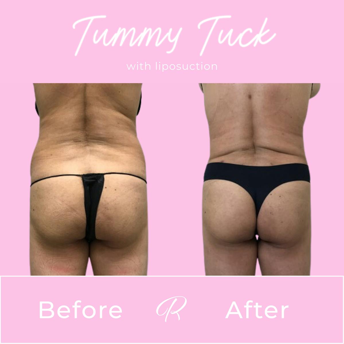 Tummy Tuck Before & After Gallery - Patient 183077061 - Image 3