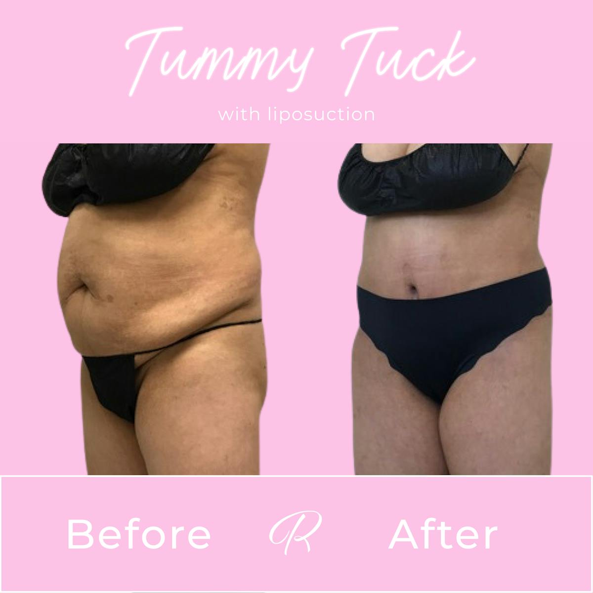 Tummy Tuck Before & After Gallery - Patient 183077061 - Image 4
