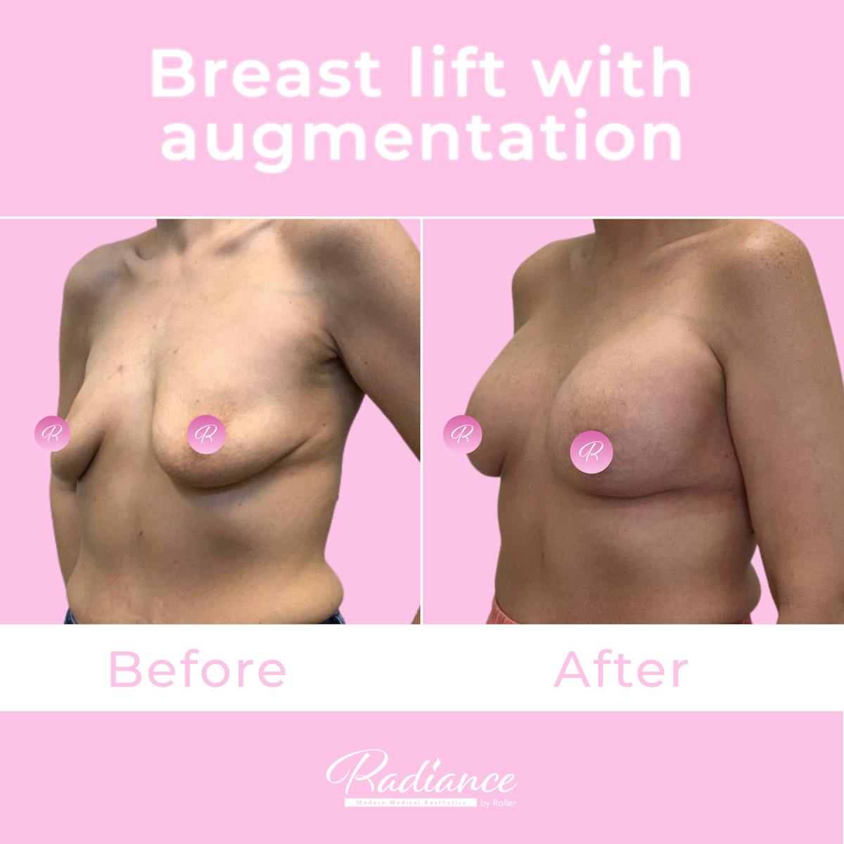 Breast Lift With Augmentation Before & After Gallery - Patient 184412408 - Image 2
