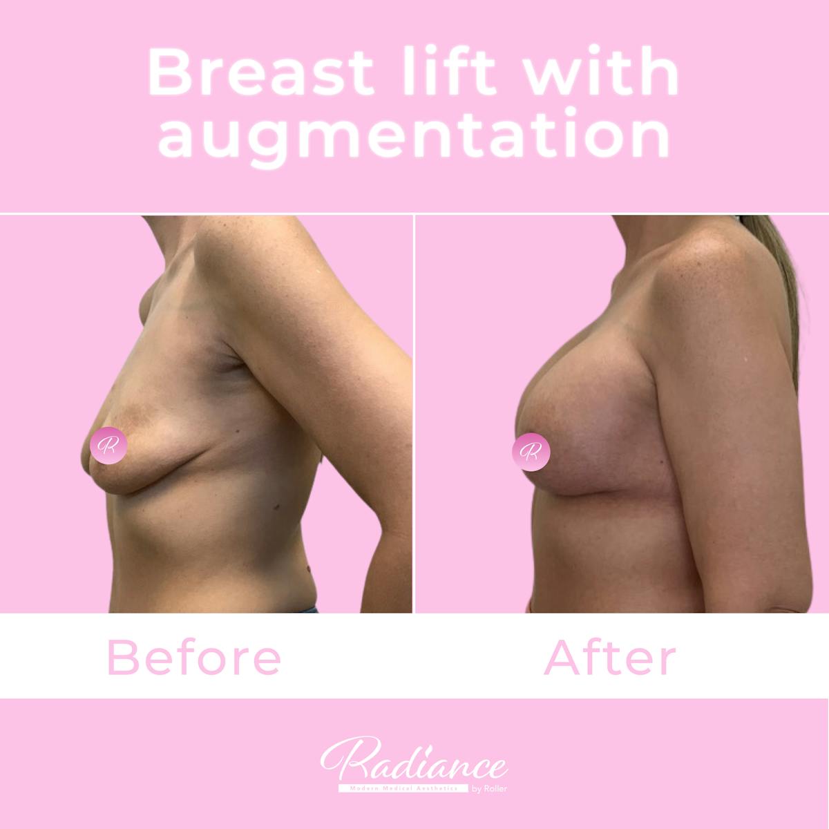 Breast Lift With Augmentation Before & After Gallery - Patient 184412408 - Image 3