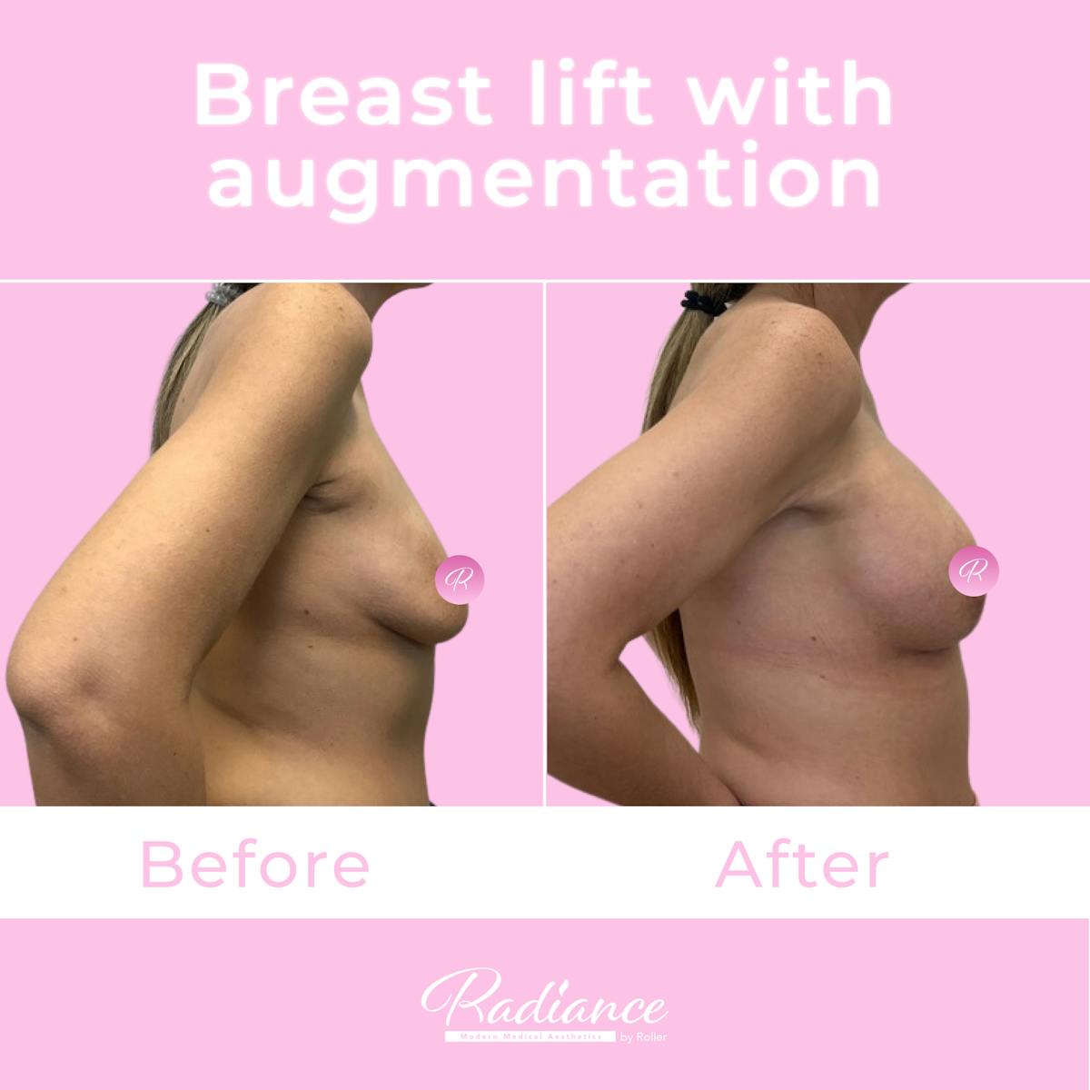 Breast Lift With Augmentation Before & After Gallery - Patient 184412408 - Image 5