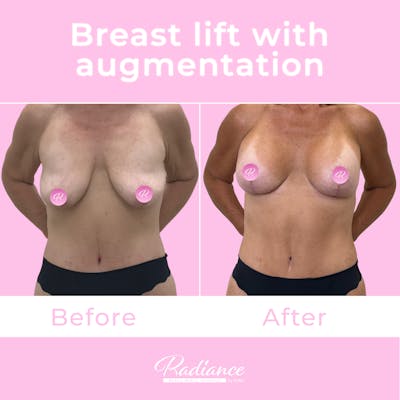 Breast Lift With Augmentation Before & After Gallery - Patient 184412407 - Image 1