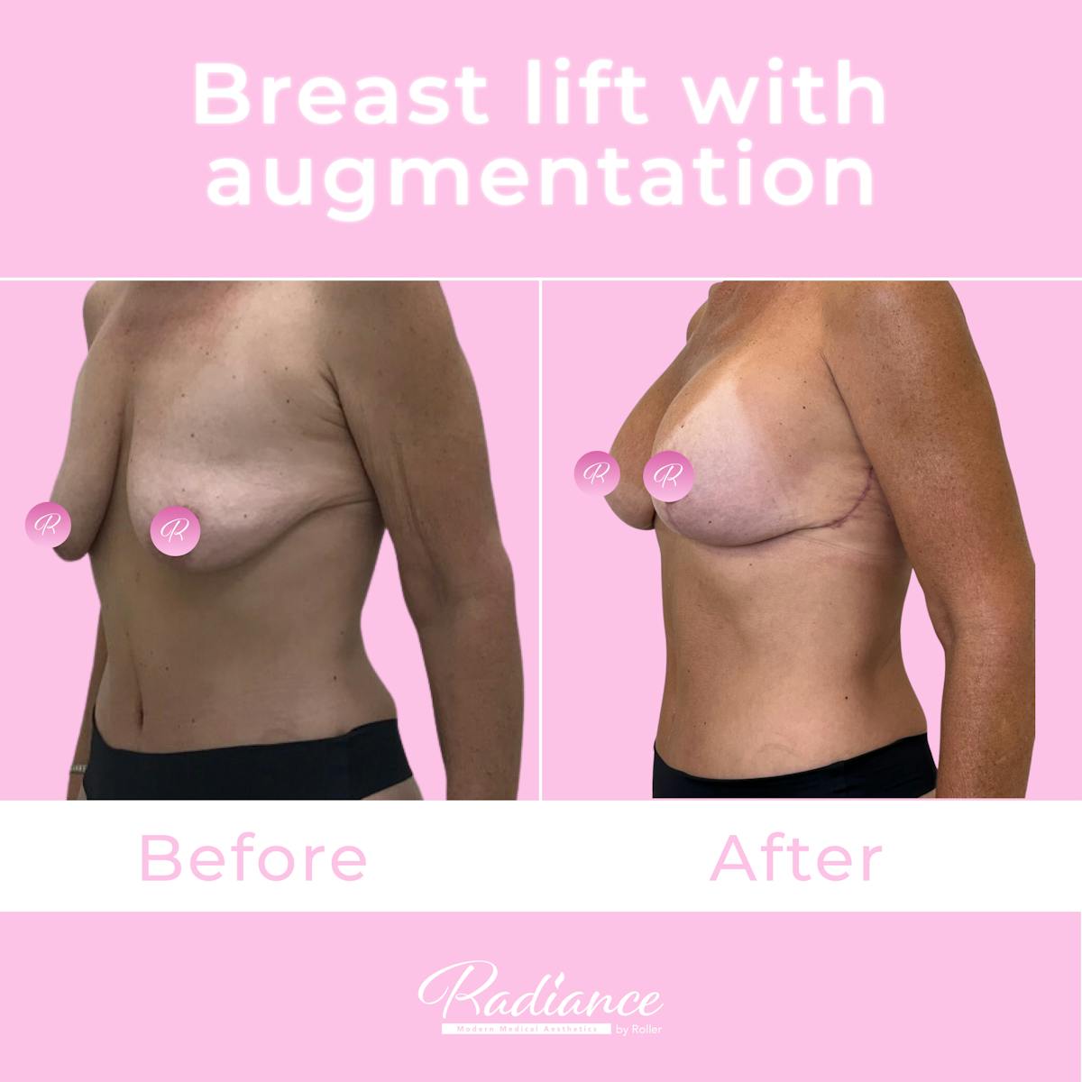 Breast Lift With Augmentation Before & After Gallery - Patient 184412407 - Image 2