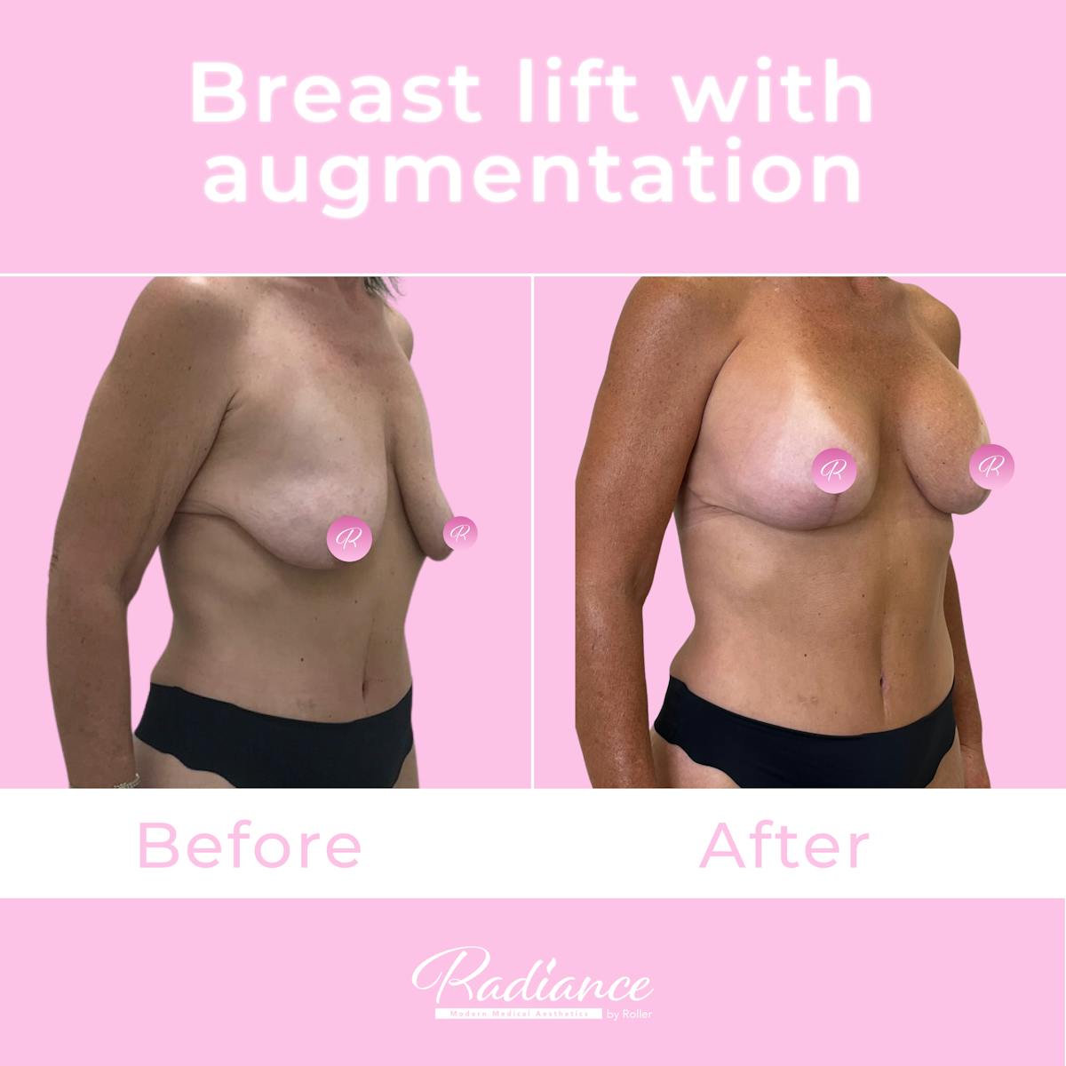 Breast Lift With Augmentation Before & After Gallery - Patient 184412407 - Image 4