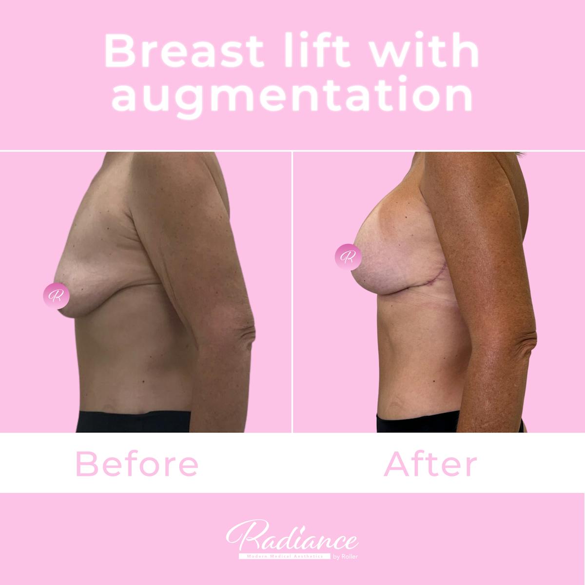 Breast Lift With Augmentation Before & After Gallery - Patient 184412407 - Image 3
