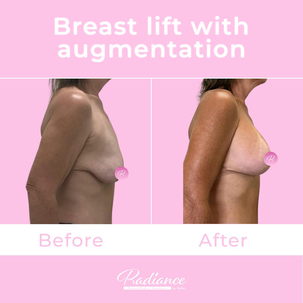 Breast Lift With Augmentation Before & After Gallery - Patient 184412407 - Image 5
