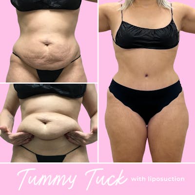 Tummy Tuck Before & After Gallery - Patient 187766618 - Image 1