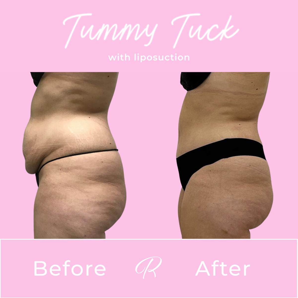 Tummy Tuck Before & After Gallery - Patient 187766618 - Image 4