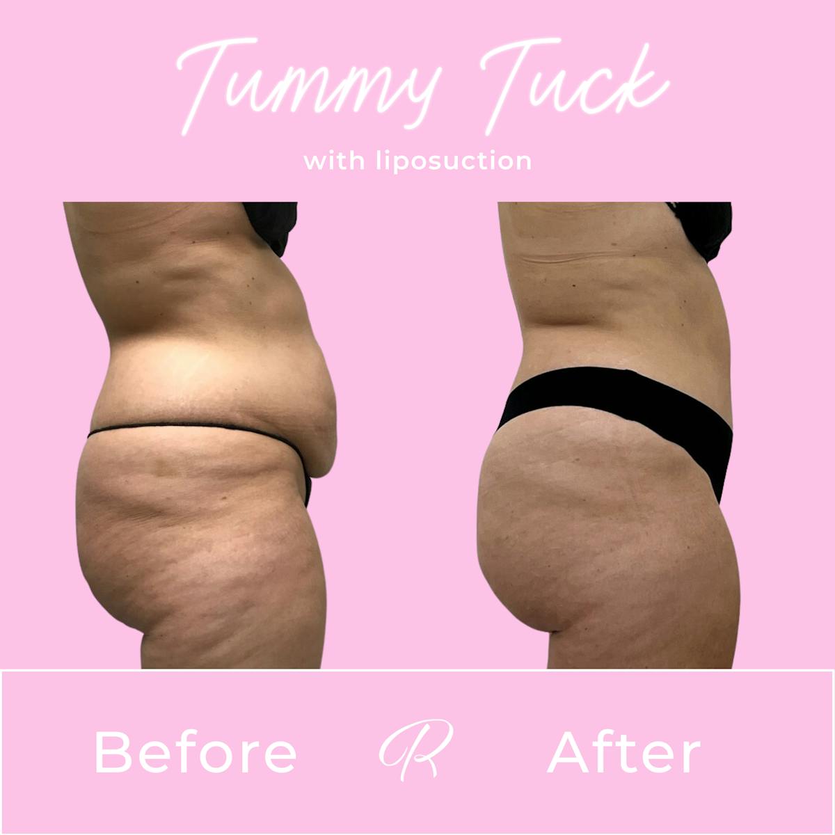 Tummy Tuck Before & After Gallery - Patient 187766618 - Image 5