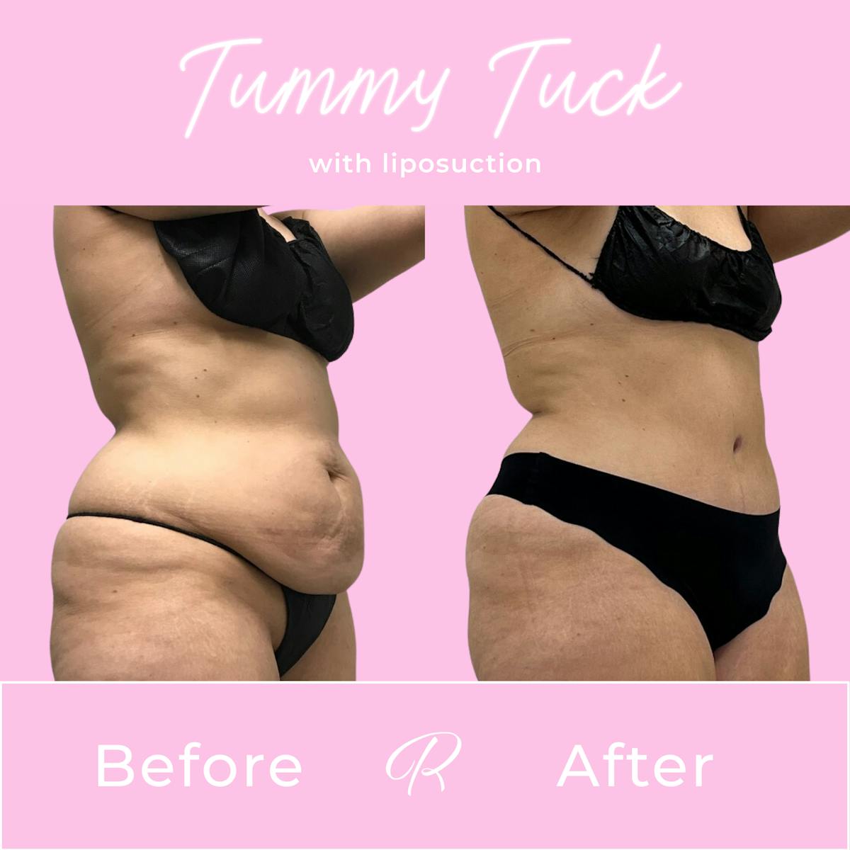 Tummy Tuck Before & After Gallery - Patient 187766618 - Image 2