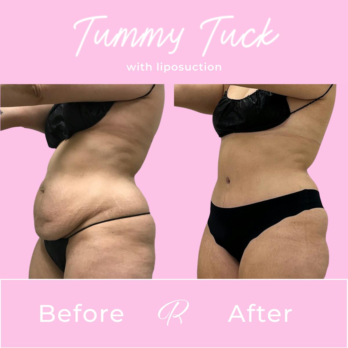Tummy Tuck Before & After Gallery - Patient 187766618 - Image 3
