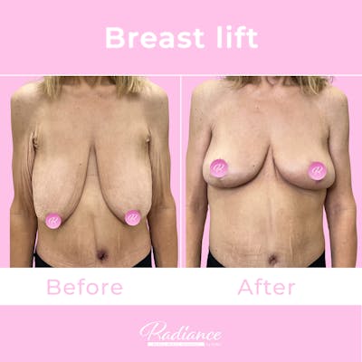 Breast Lift Before & After Gallery - Patient 153358 - Image 1