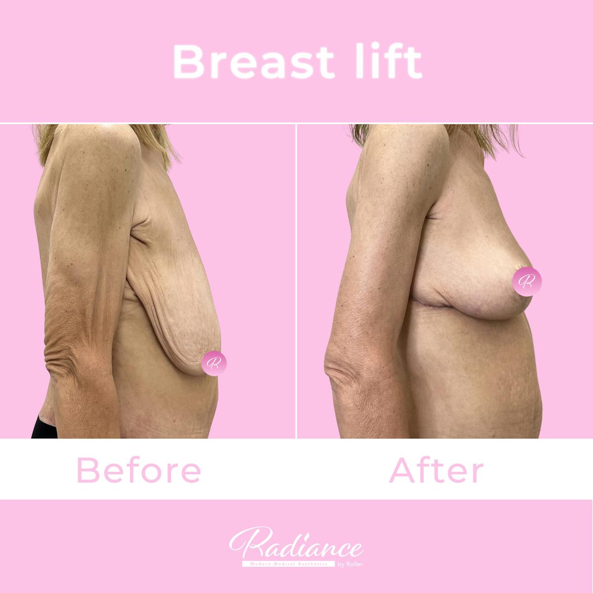 Breast Lift Before & After Gallery - Patient 153358 - Image 3
