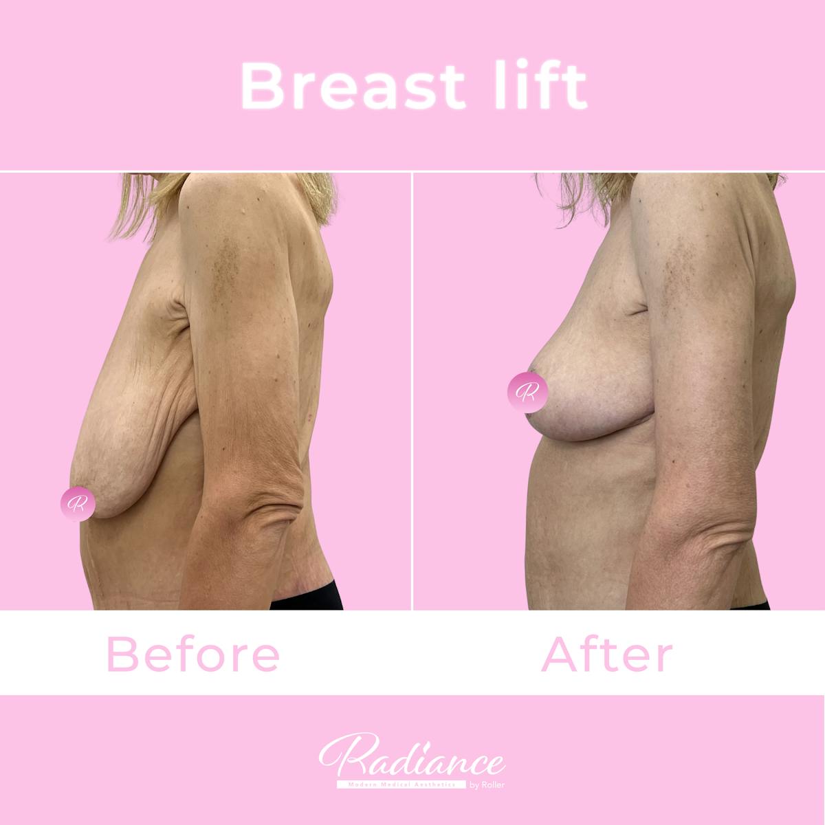 Breast Lift Before & After Gallery - Patient 153358 - Image 2