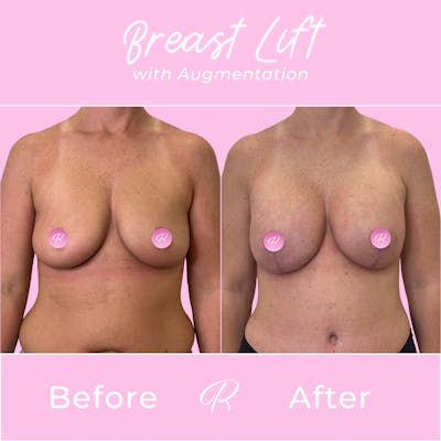 Breast Lift With Augmentation Before & After Gallery - Patient 253522 - Image 1
