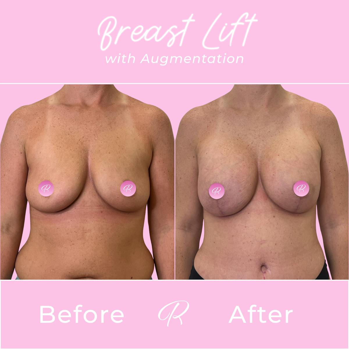 Breast Lift With Augmentation Before & After Gallery - Patient 253522 - Image 1