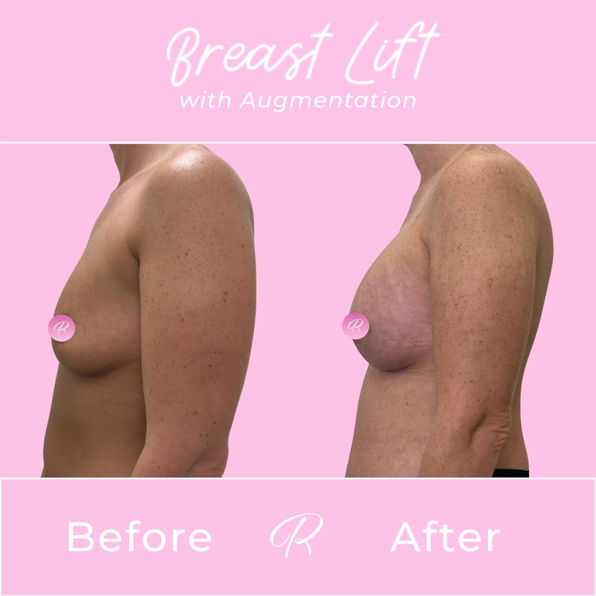Breast Lift With Augmentation Before & After Gallery - Patient 253522 - Image 2