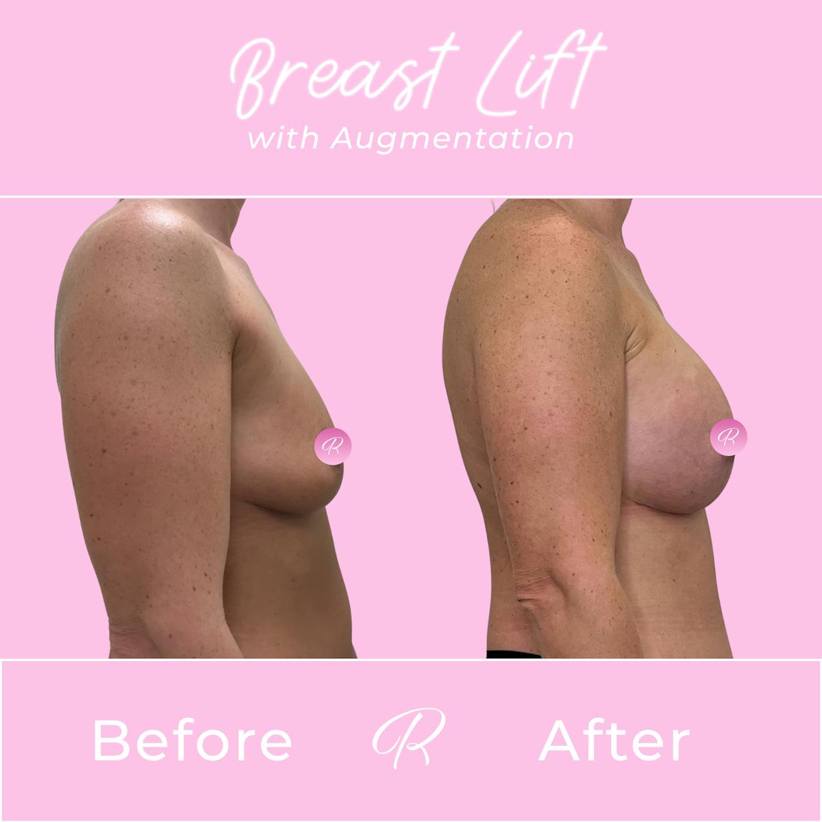Breast Lift With Augmentation Before & After Gallery - Patient 253522 - Image 3