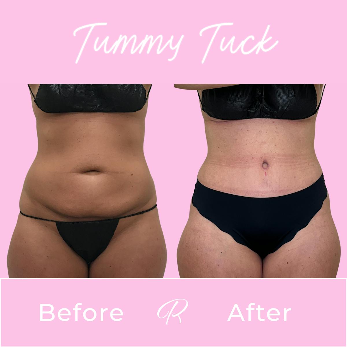 Tummy Tuck Before & After Gallery - Patient 610617 - Image 1