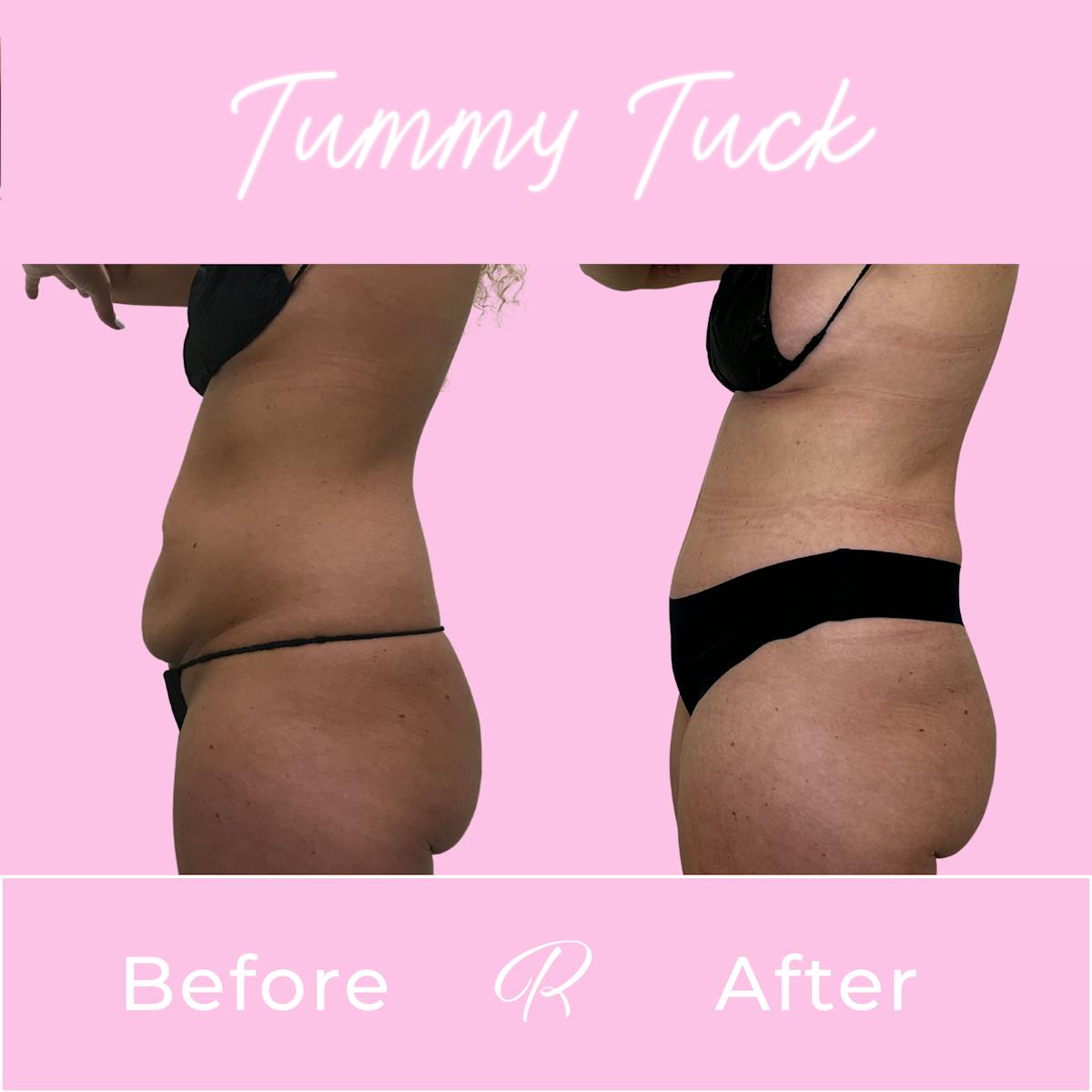 Tummy Tuck Before & After Gallery - Patient 610617 - Image 2