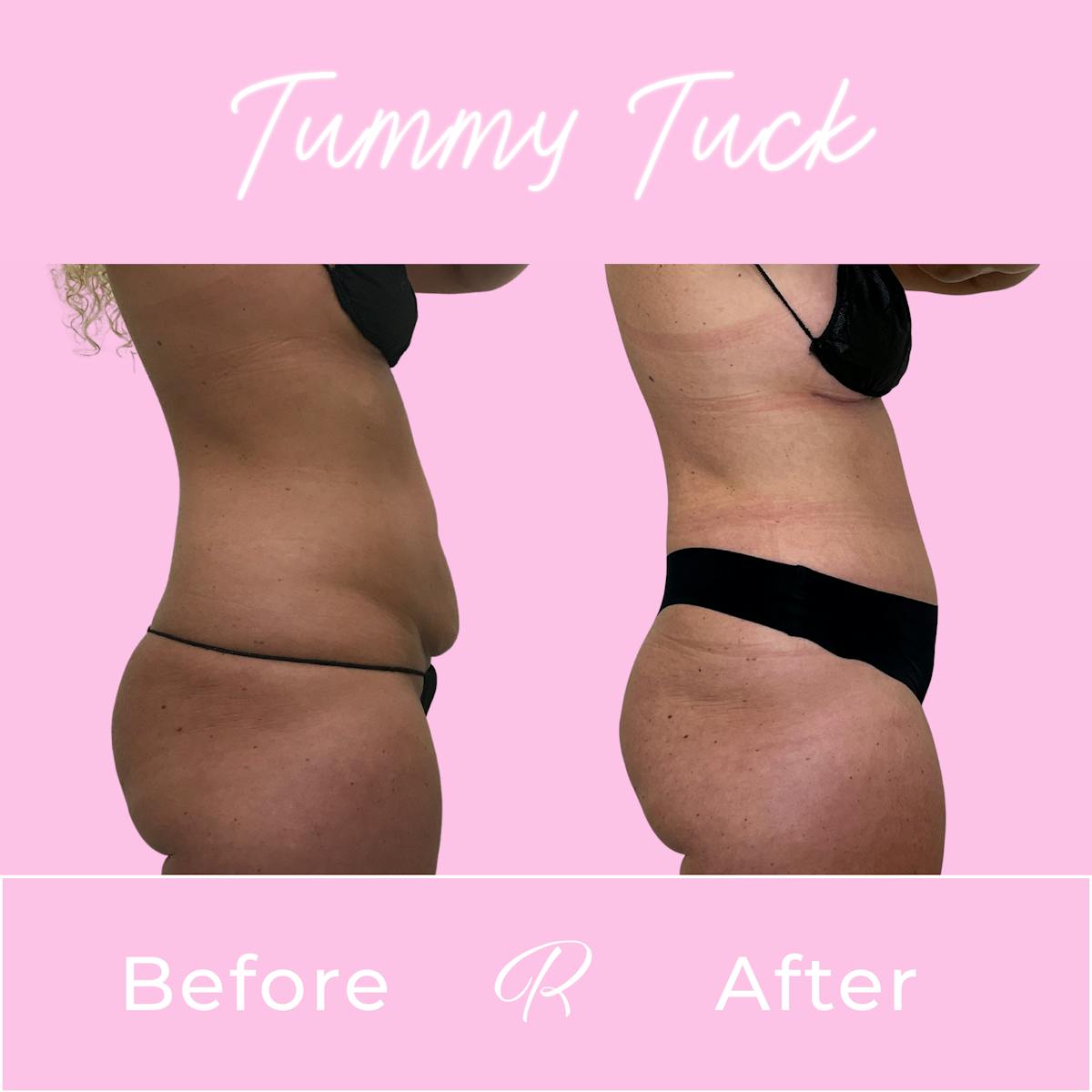 Tummy Tuck Before & After Gallery - Patient 610617 - Image 3