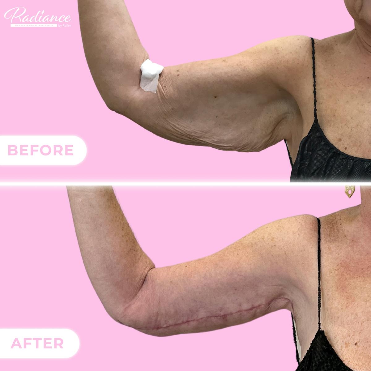 Arm Lift Before & After Gallery - Patient 128670 - Image 1