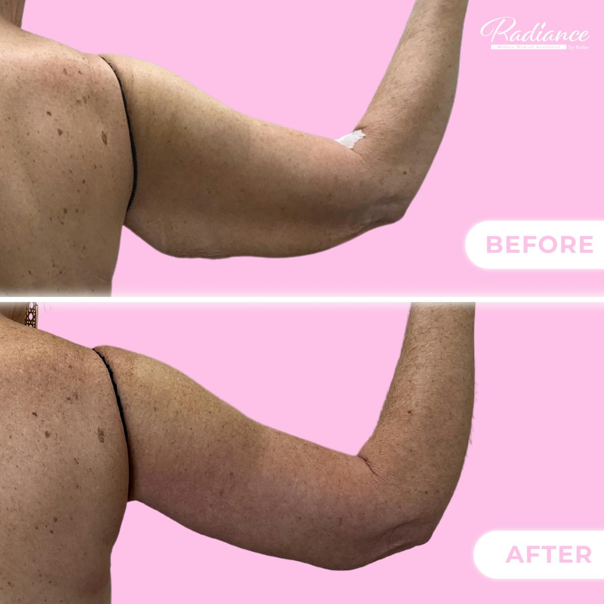 Arm Lift Before & After Gallery - Patient 128670 - Image 2