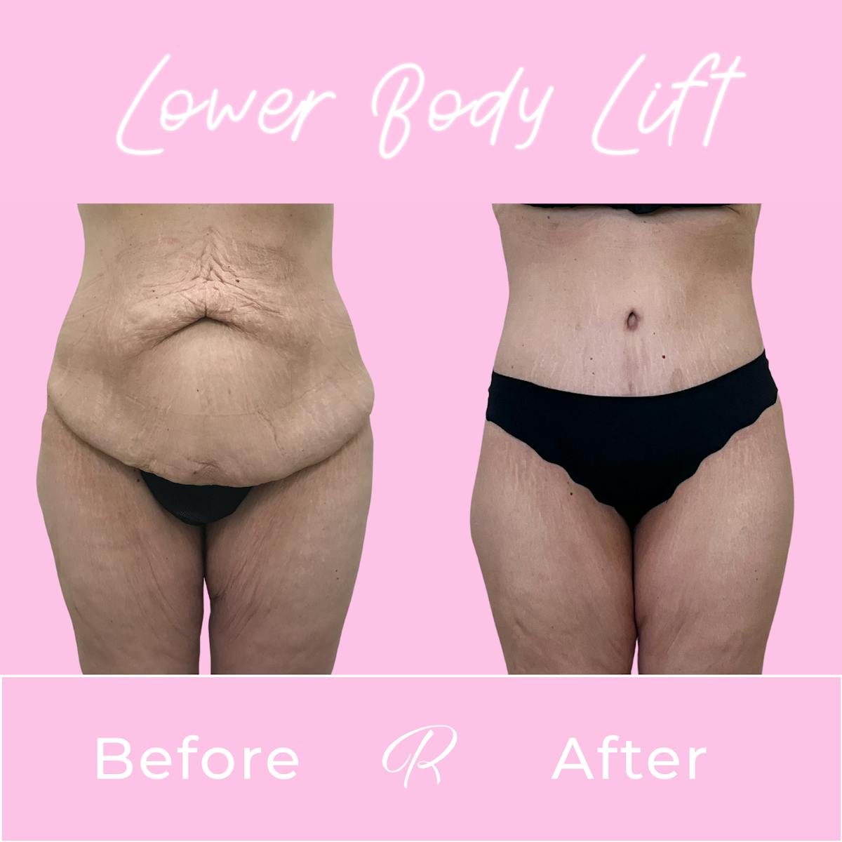 Lower Body Lift Before & After Gallery - Patient 979053 - Image 1