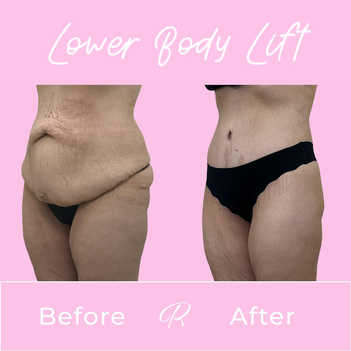 Lower Body Lift Before & After Gallery - Patient 979053 - Image 2
