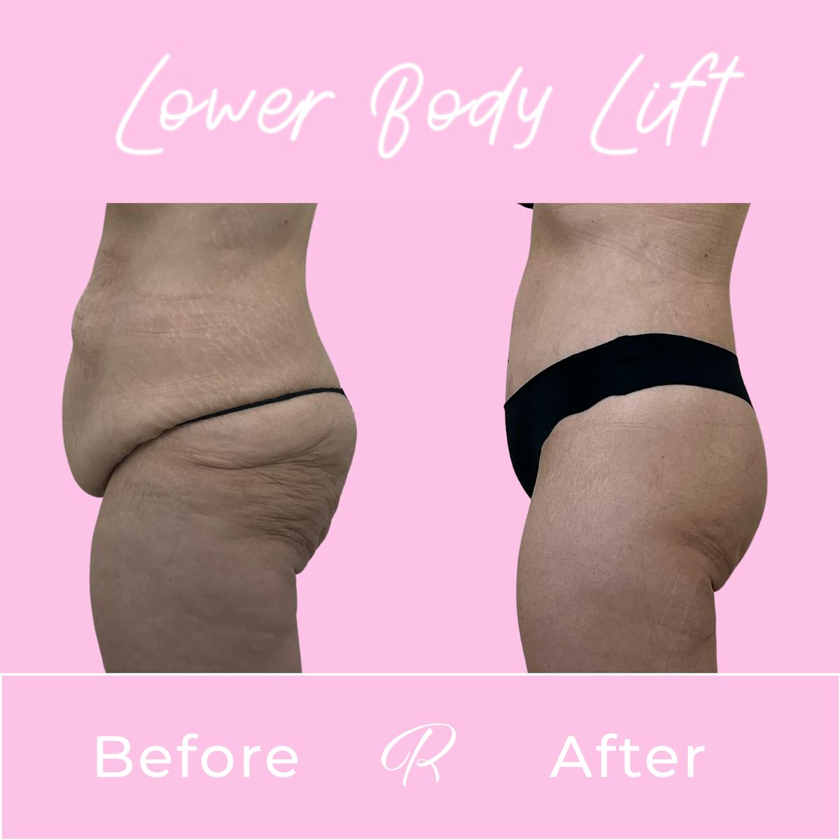 Lower Body Lift Before & After Gallery - Patient 979053 - Image 3