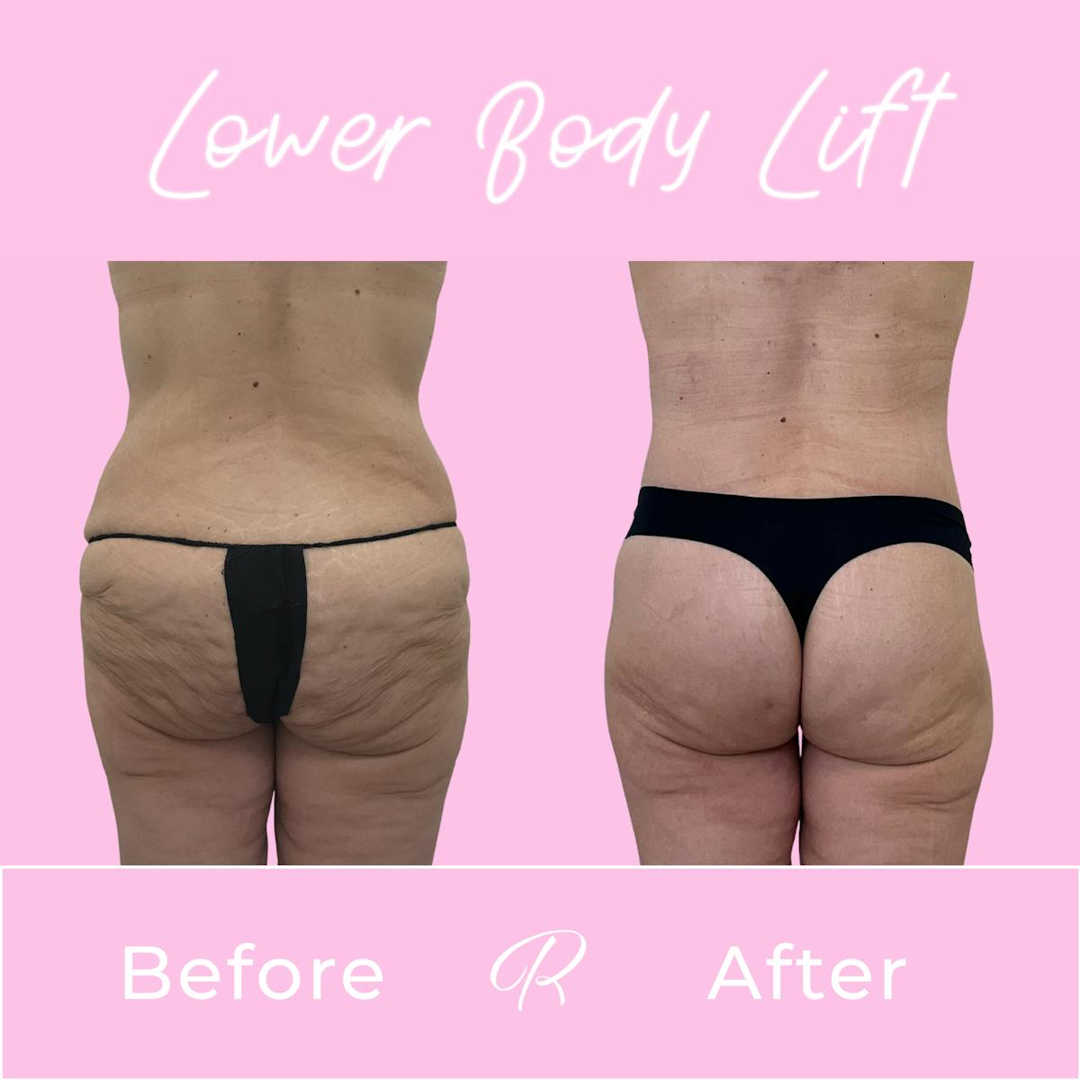 Lower Body Lift Before & After Gallery - Patient 979053 - Image 4