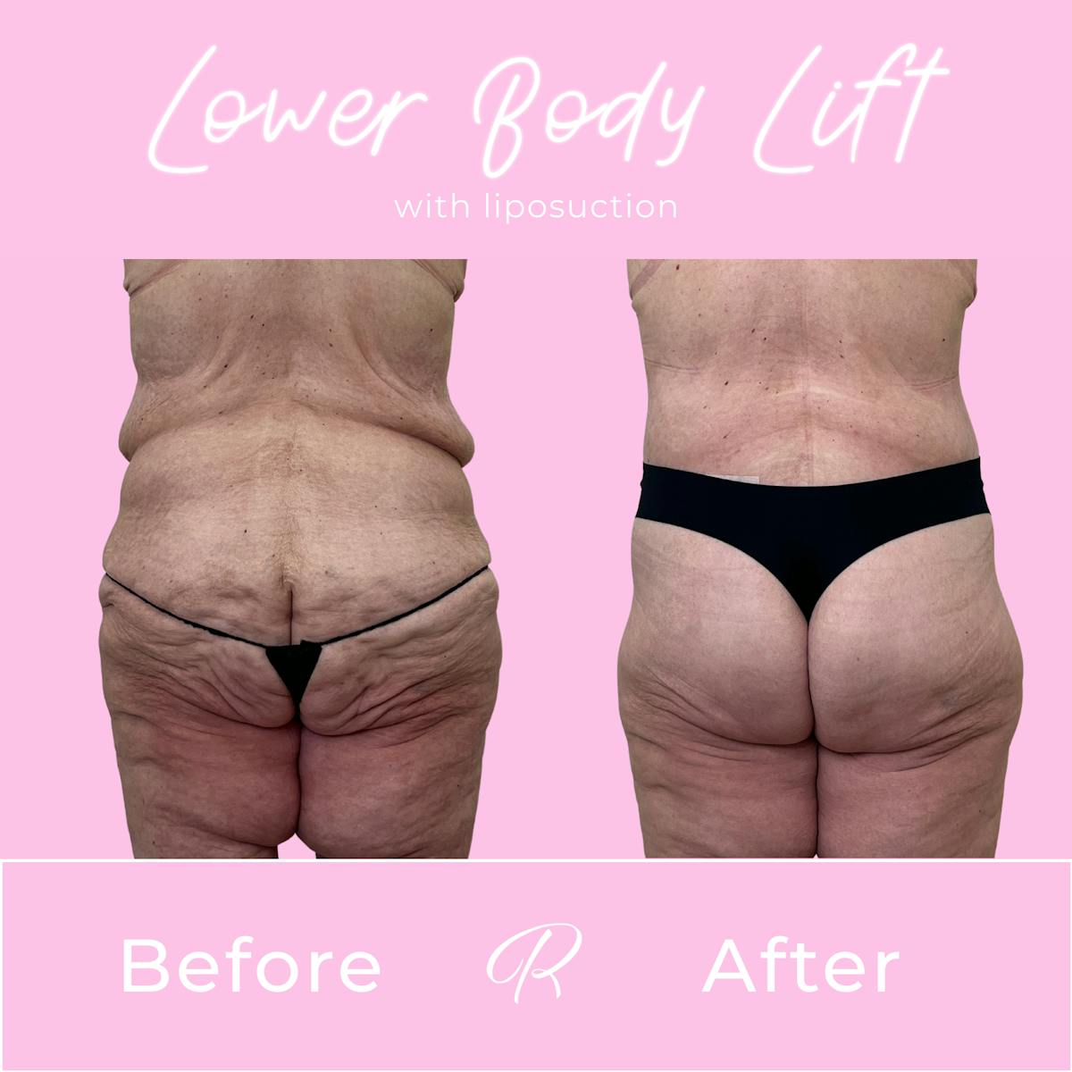 Lower Body Lift Before & After Gallery - Patient 376362 - Image 2