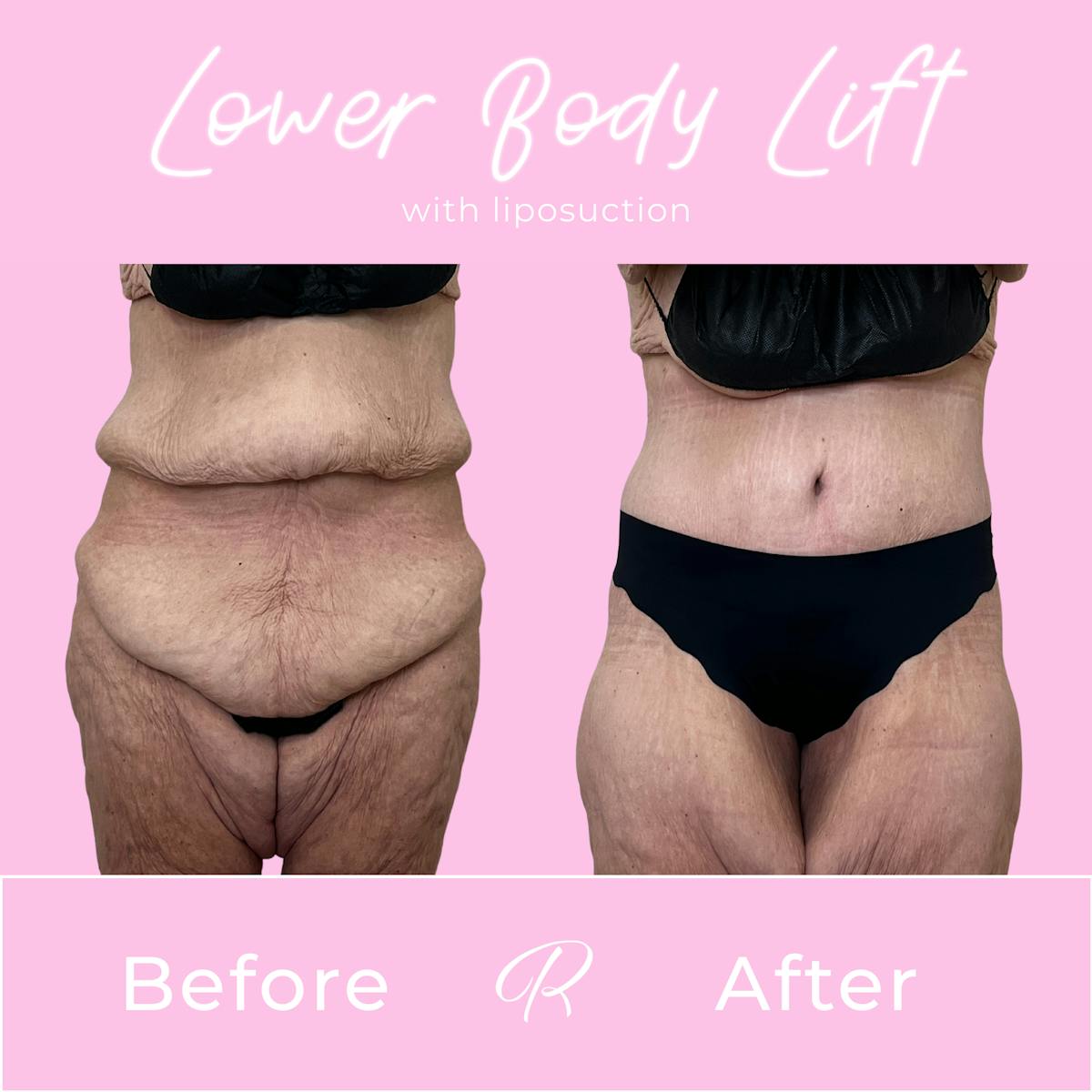 Lower Body Lift Before & After Gallery - Patient 376362 - Image 1