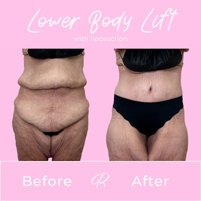 Lower Body Lift Before & After Gallery - Patient 376362 - Image 1