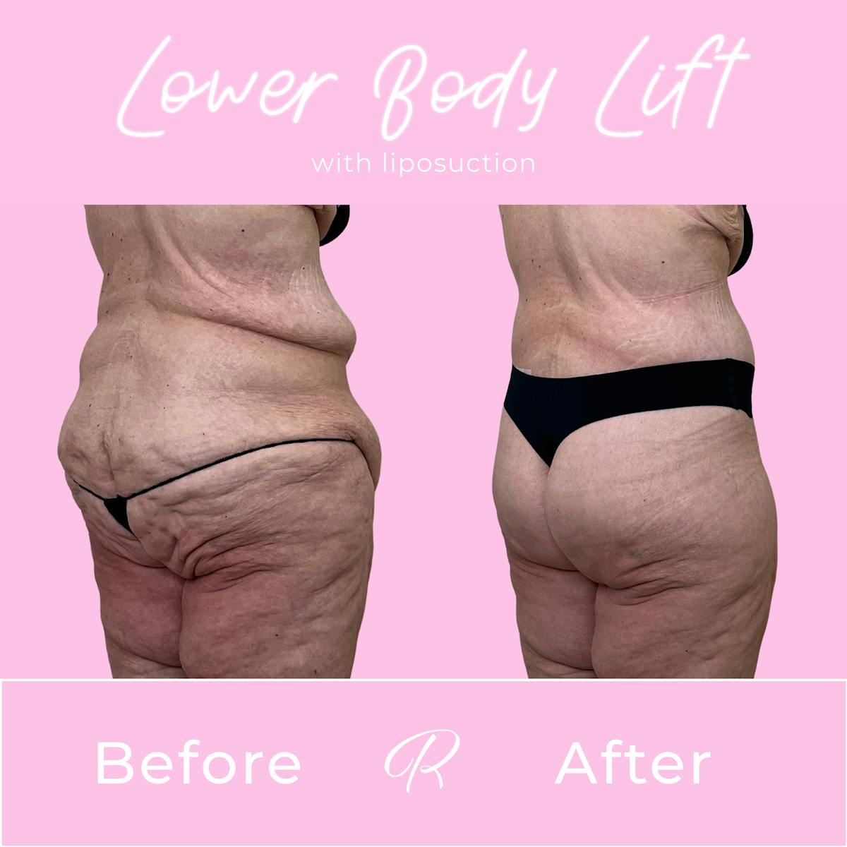 Lower Body Lift Before & After Gallery - Patient 376362 - Image 3