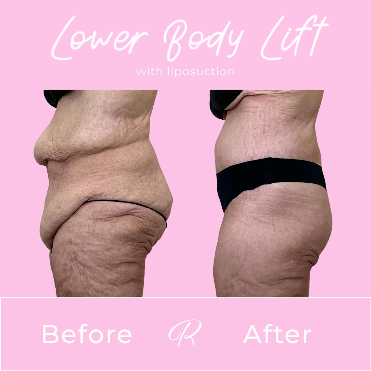 Lower Body Lift Before & After Gallery - Patient 376362 - Image 4