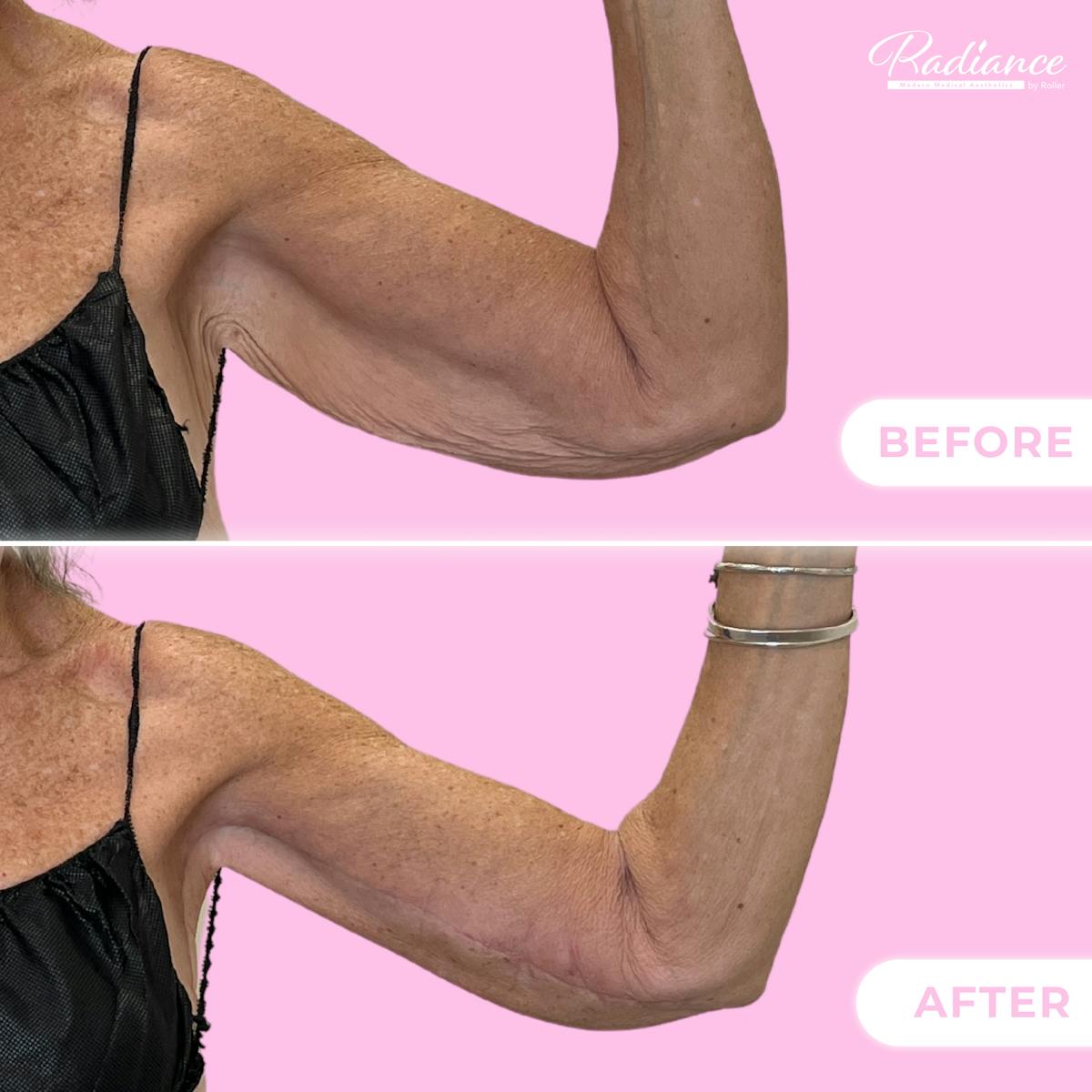Arm Lift Before & After Gallery - Patient 130398 - Image 1