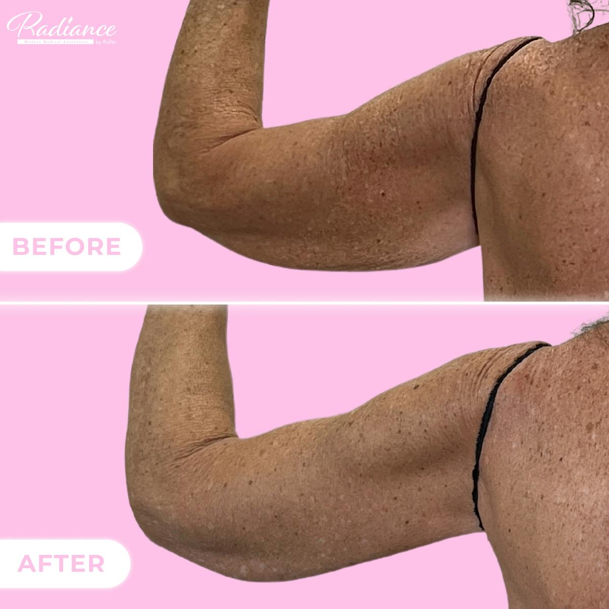 Arm Lift Before & After Gallery - Patient 130398 - Image 2