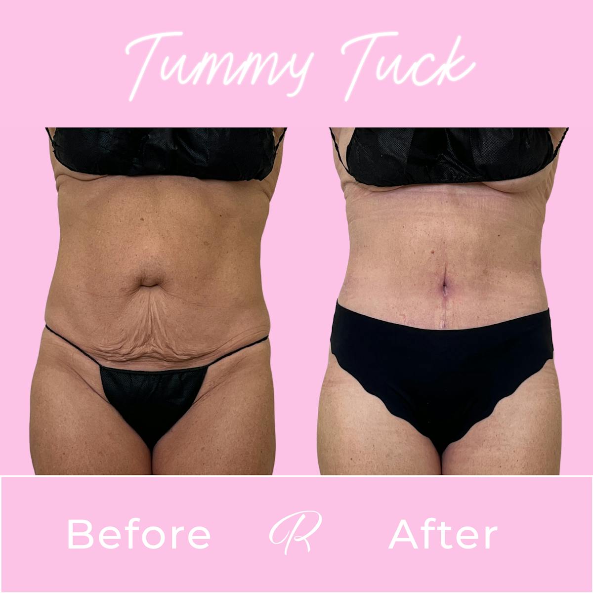 Tummy Tuck Before & After Gallery - Patient 399621 - Image 1