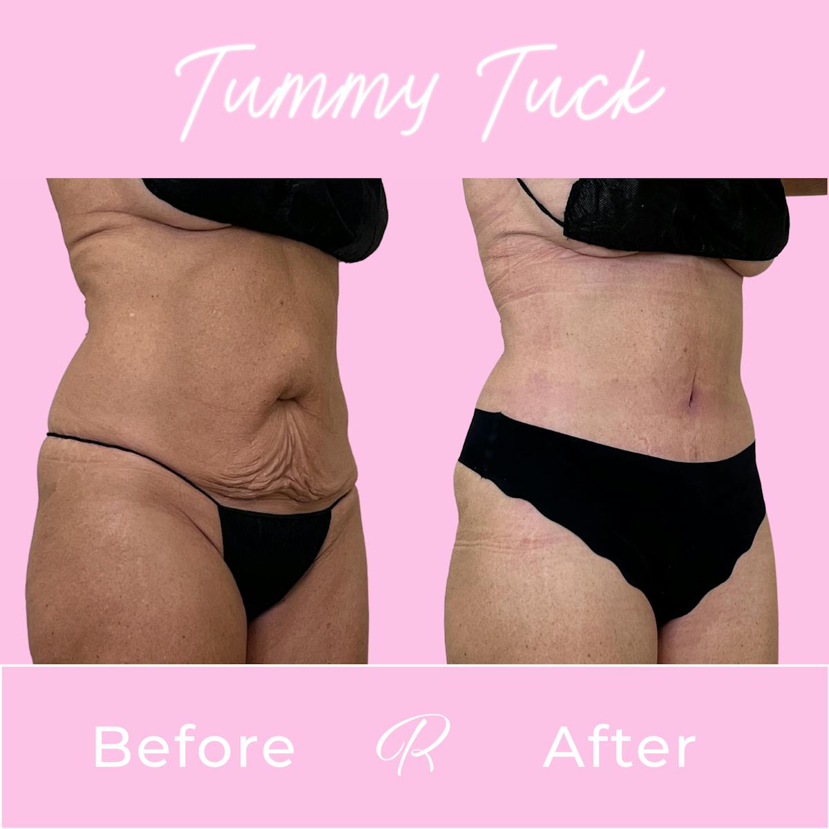 Tummy Tuck Before & After Gallery - Patient 399621 - Image 2