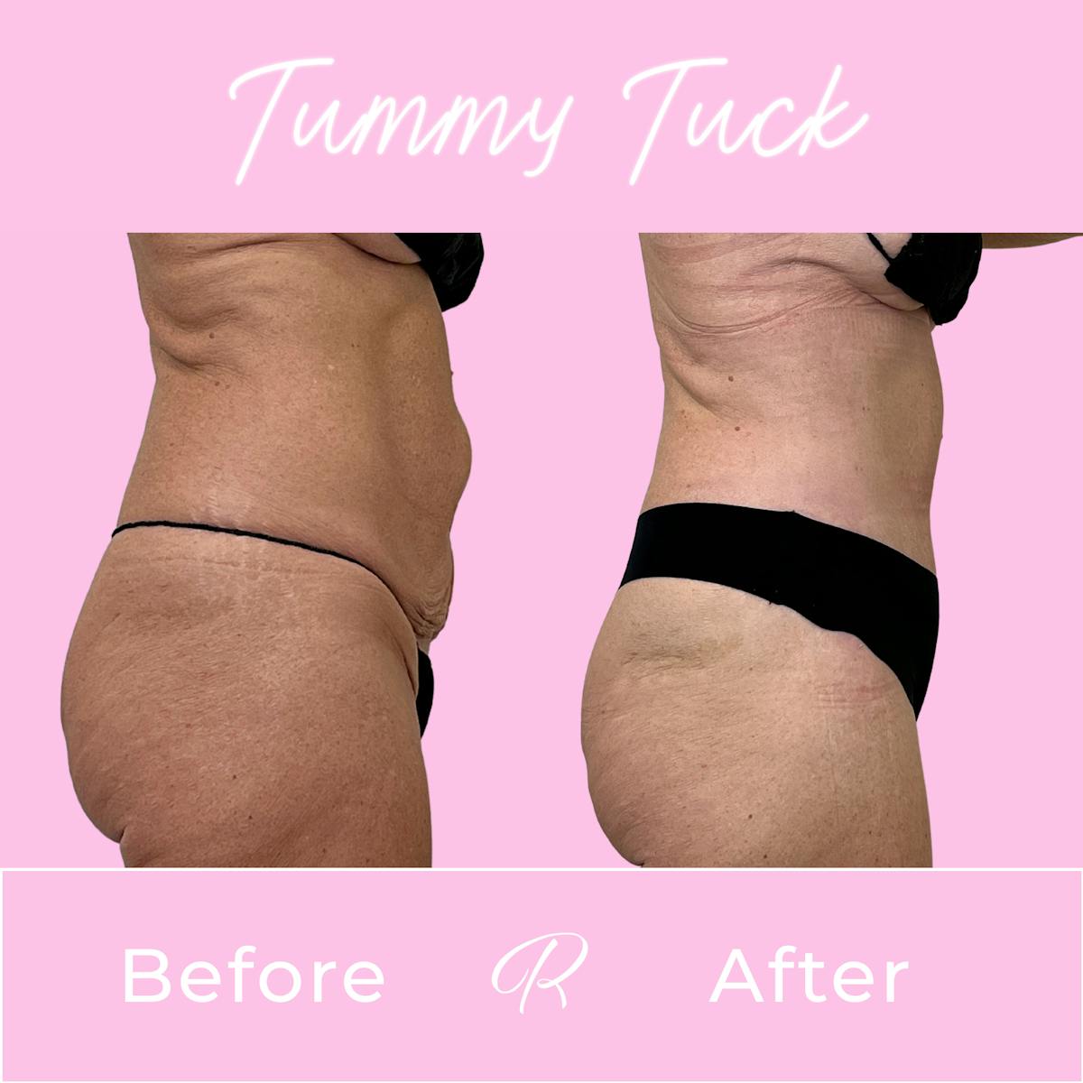 Tummy Tuck Before & After Gallery - Patient 399621 - Image 3