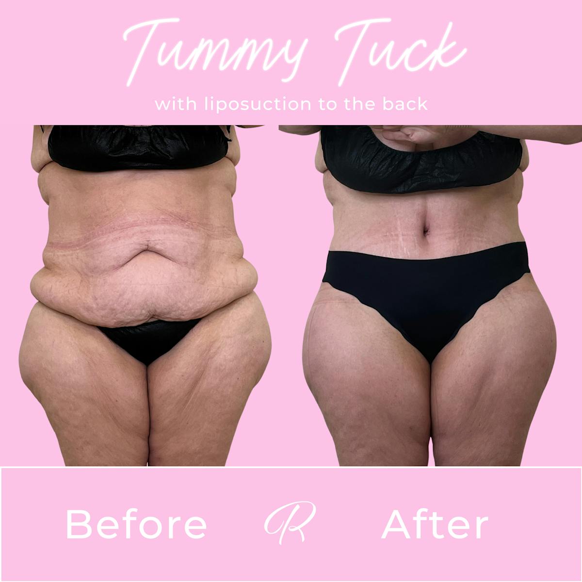 Tummy Tuck Before & After Gallery - Patient 401333 - Image 1